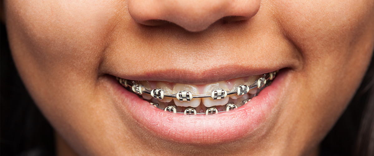 Tipos de brackets, ¿sabes cuáles hay? Clínica Dental Doctor Moreno
