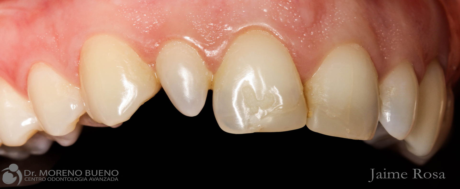 tratamiento dental antes y después