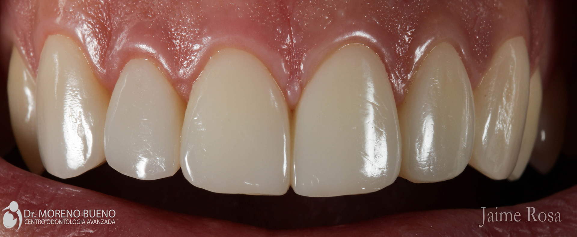 tratamiento dental antes y después